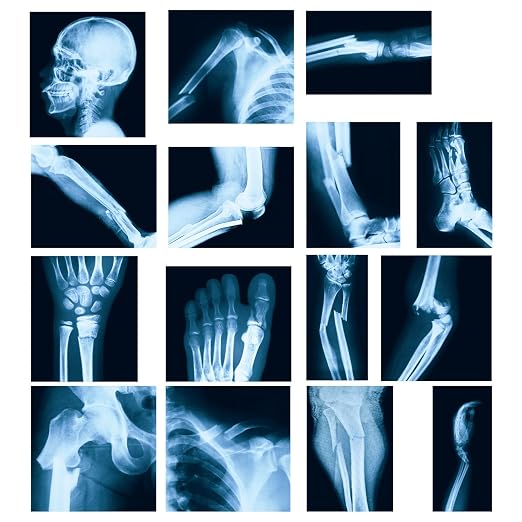 Sayglossy 15 Pcs Broken Bones x Ray Set Human x Rays Black and Blue Skeleton Pretend Xrays for Kids by Sayglossy